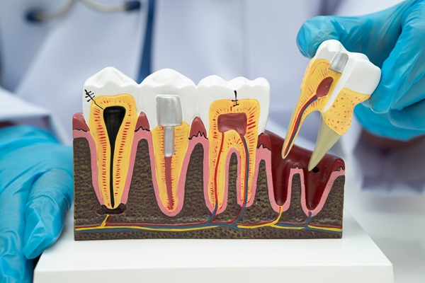 Pain And Root Canals: What You Should Know